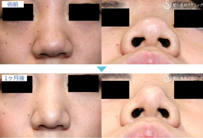 老後の鼻整形：考慮すべき点