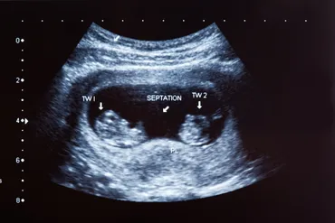 双子妊娠って、どんな感じ？妊娠超初期症状から確定までを徹底解説!!