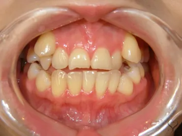 乱杭歯の八重歯はセラミック矯正で改善可能 