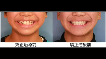12歳 男性 「 八重歯 ガチャガチャ を治したい 」 （ 抜歯症例 ） 
