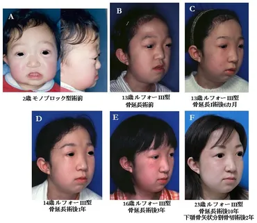 クルーゾン症候群・アペール症候群・ファイファー症候群など「頭蓋骨縫合早期癒合症」による頭蓋-顔面変形の治療