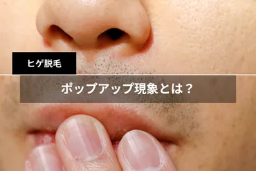 ヒゲ脱毛後に起こるポップアップ現象とは?原理やいつから起こるかを解説