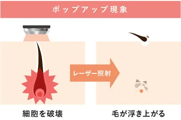 脱毛後に抜ける毛を引っ張るのはNG!ポップアップ現象の対処法