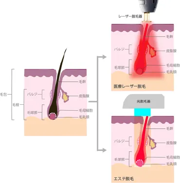 医療レーザー脱毛とエステ脱毛との違い