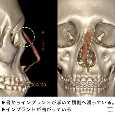 シリコンで失敗した鼻整形のよくある修正パターン5つを写真で見る