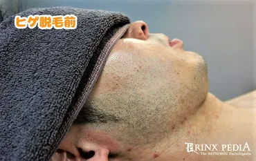 ヒゲ脱毛後に起きる「どろぼうヒゲ」の原因と対策