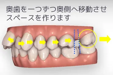 目立たない・取り外せるマウスピース矯正（インビザライン）