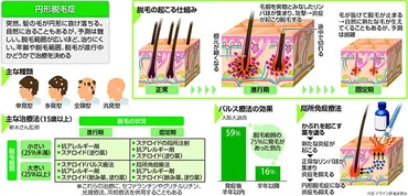 円形脱毛症…免疫異常で毛根に炎症 