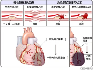 心筋梗塞って？介護現場で起こったらどうすればいいの？介護現場での心筋梗塞対応とは！？