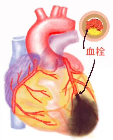 心筋梗塞の胸部症状