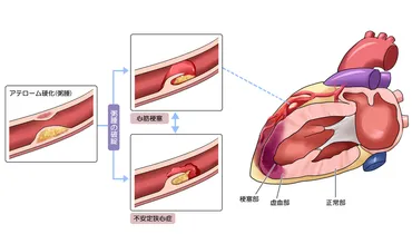 心筋梗塞の原因や予防方法 ―生活習慣病やタバコは発症リスクとなる？ 