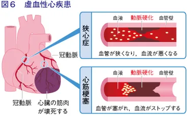 知っておきたい動脈硬化