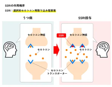 うつ病の薬物療法 