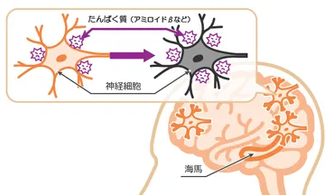 認知症って一体なんなの？認知症について詳しく解説!!