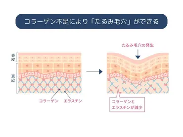 たるみ毛穴の原因とは？改善に導くスキンケア方法や予防法を解説！ 