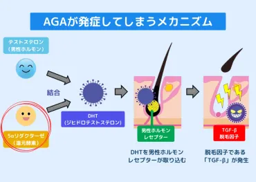 DHT（ジヒドロテストステロン）を抑制する5つの方法 