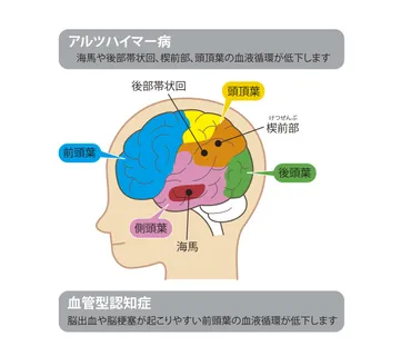 認知症予防は脳卒中対策が効く。血管性認知症の原因と症状とは