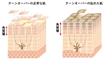 角質ケアって本当に必要？肌のターンオーバーと美肌の関係とは？角質ケアの重要性とは！？