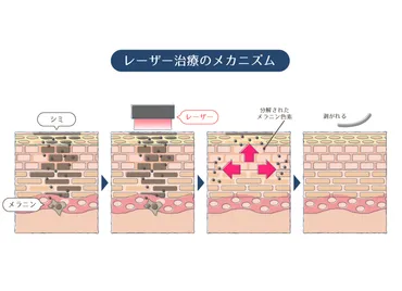 シミを消す方法とは？美白ケアの真実とは！？