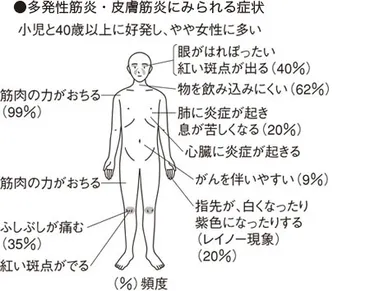 多発性筋炎・皮膚筋炎〔たはつせいきんえん・ひふきんえん〕