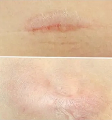 画像あり】ワキガ手術で傷跡は残らないの？経過や治療方法 