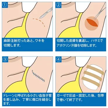 わきが・多汗症治療 