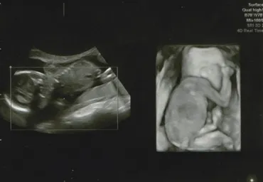 医療監修】エコー写真を妊娠の経過別に紹介！写真の見方や性別の見分け方 ママリ