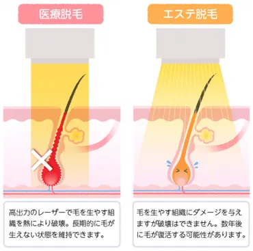 医療脱毛完全ガイド：回数、料金、効果を徹底解説！(永久脱毛？)メンズ脱毛を成功させるには？医療脱毛の基礎知識と選び方