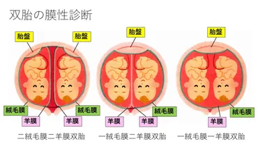 DD双胎・MD双胎・MM双胎について 