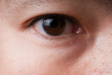 目に濁りがあるのは病気？病気の種類や治療法、予防法を詳しく解説！ 