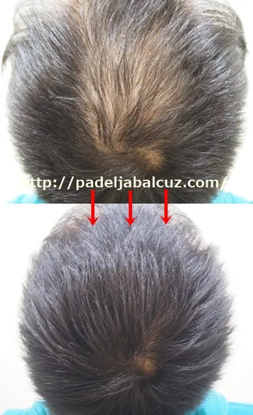 林社長がやったトルコ植毛はデンジャラス？実施済みの筆者が導き出す6つのリスクとは？ 