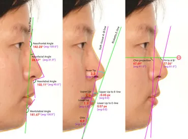 歯列矯正後の横顔の変化を比較！きれいなEラインを実現した症例 