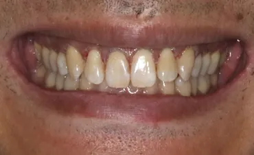 ガミースマイルは芸能人に多い？治し方や原因についても解説 