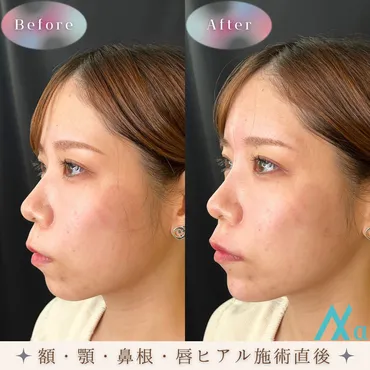 半永久的に持続する鼻ヒアルロン酸注射：鼻整形の効果と注意点 