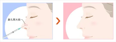 小鼻縮小ボトックス注射 