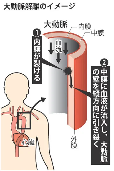 大動脈解離:突然死の主な原因
