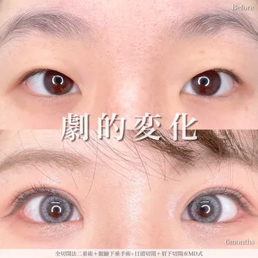 眉下切開で眼瞼下垂は改善できるかを医師が解説