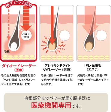VIO脱毛で知っておきたいこと？火傷には要注意！！
