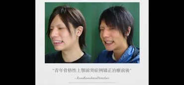 矯正歯科鎌倉 dentofacoにおける矯正・顎顔面整形歯科治療結果2)青年期男性 – 矯正歯科 : カマクラデントフェイシャルオーソピディクス 山本 歯科・矯正