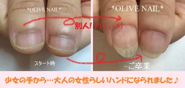 マムシ指改善矯正ってなぁに?