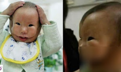 【閲覧注意】医師は生まれたばかりの赤ちゃんを母に見せるのを拒んだ…稀な出生異常で男の子の顔は、2つに割れていたからだった